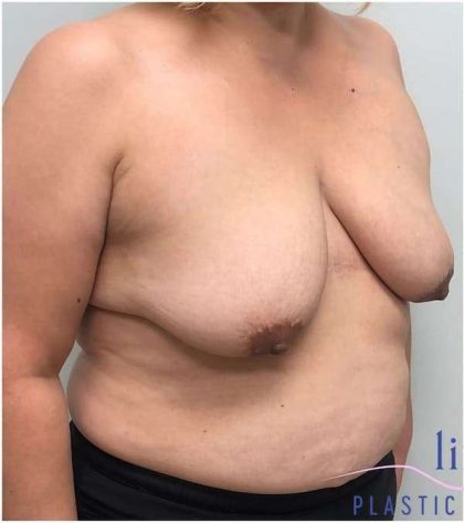 Breast Lift Before & After Patient #1040