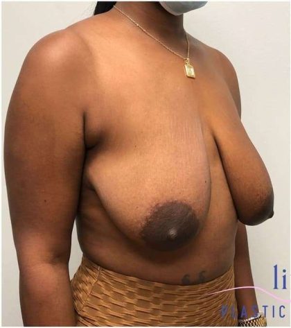 Breast Lift Before & After Patient #1051