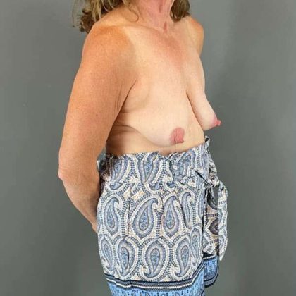 Breast Lift Before & After Patient #1073