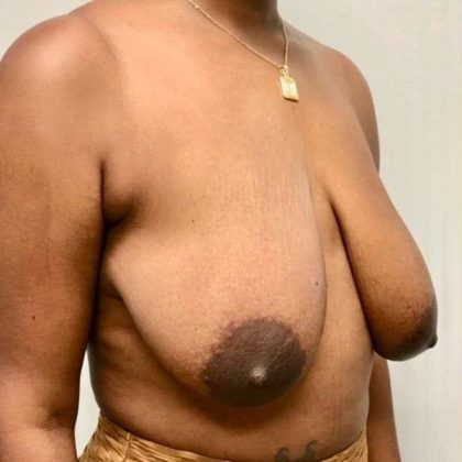Breast Lift Before & After Patient #1084
