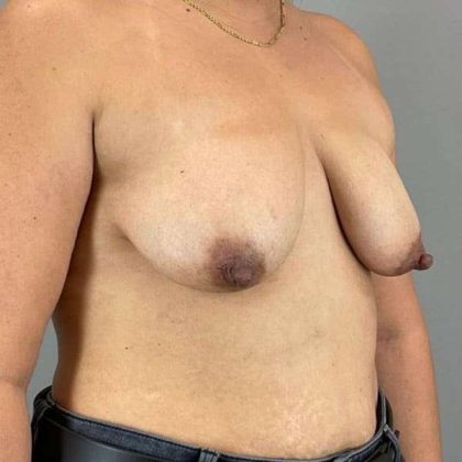 Breast Lift Before & After Patient #1109