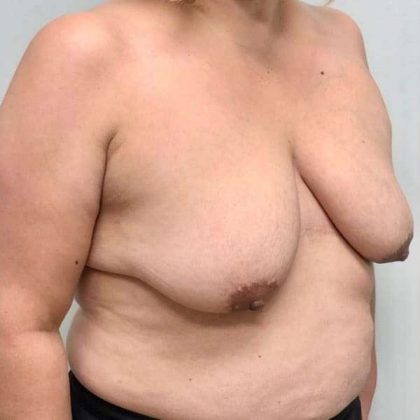 Breast Lift Before & After Patient #1120