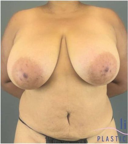 Breast Lift Before & After Patient #1131