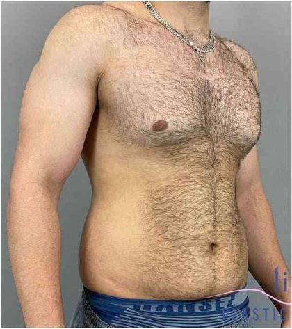 Bodytite Before & After Patient #280