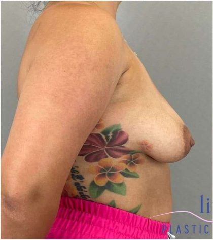 Breast Augmentation Before & After Patient #1230