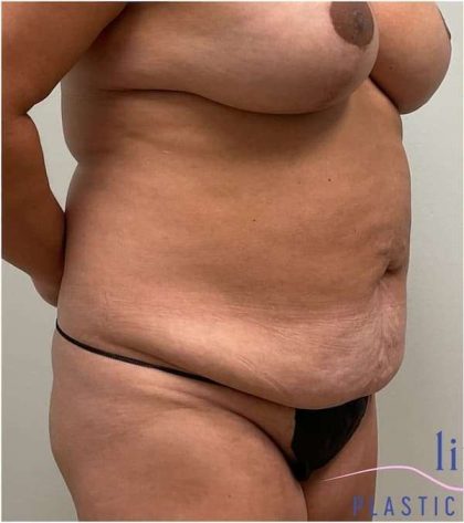 Tummy Tuck Before & After Patient #303