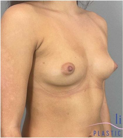 Breast Augmentation Before & After Patient #1252