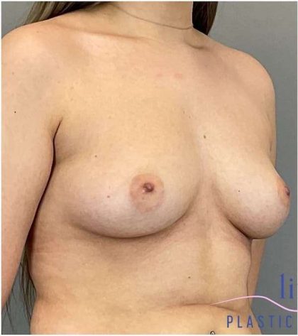 Breast Augmentation Before & After Patient #1285