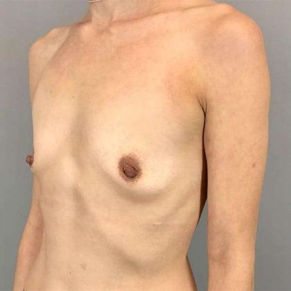 Breast Augmentation Before & After Patient #1329