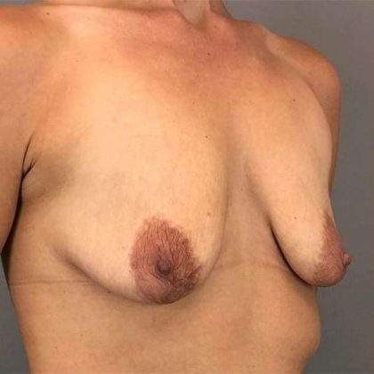 Breast Augmentation Before & After Patient #1351