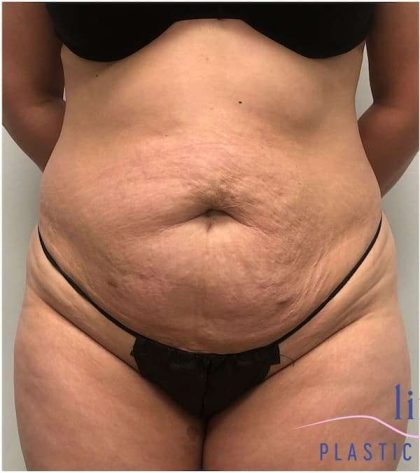 Tummy Tuck Before & After Patient #357