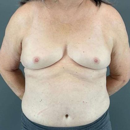 Breast Augmentation Before & After Patient #1450