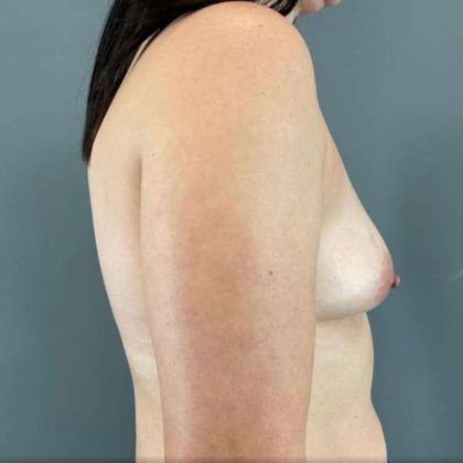 Breast Augmentation Before & After Patient #1472