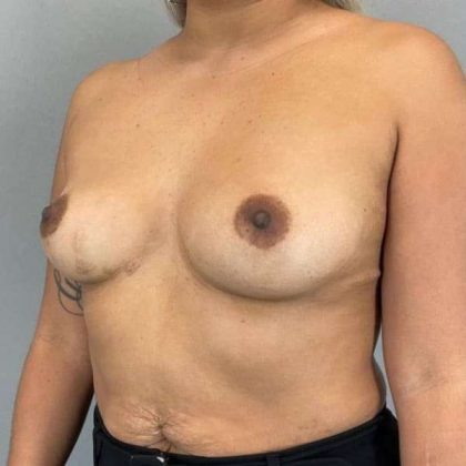 Breast Augmentation Before & After Patient #1483