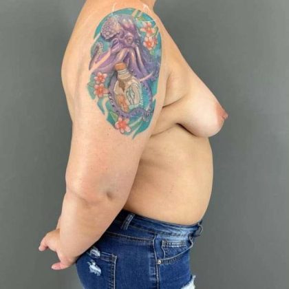 Breast Augmentation Before & After Patient #1494