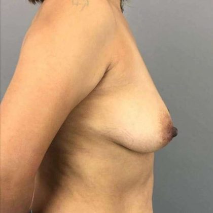 Breast Augmentation Before & After Patient #1525
