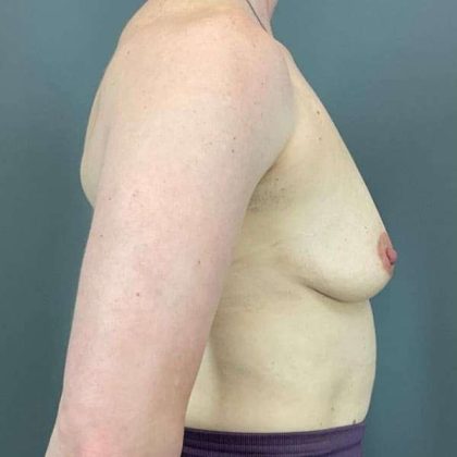 Breast Augmentation Before & After Patient #1547