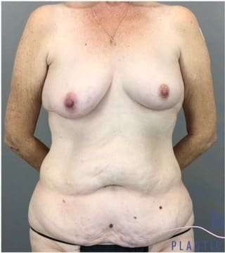 Tummy Tuck Before & After Patient #368