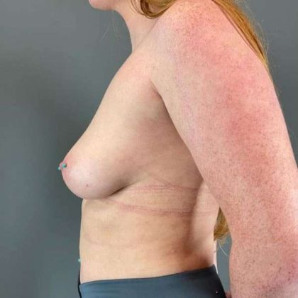 Breast Augmentation Before & After Patient #1558