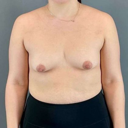 Breast Augmentation Before & After Patient #1591