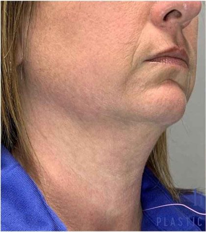 Necktite Before & After Patient #1624