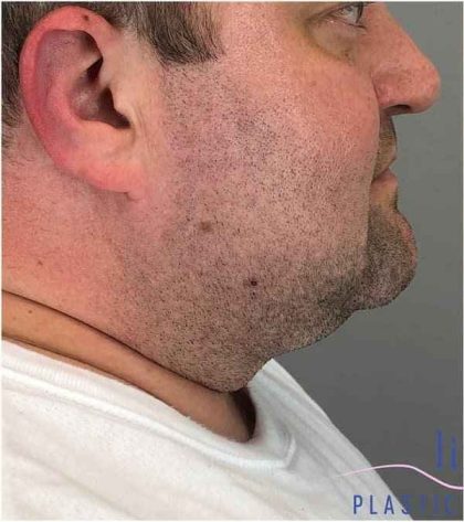 Neck Lift Before & After Patient #1660