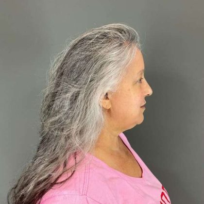 Neck Lift Before & After Patient #1671