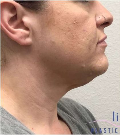 Neck Lift Before & After Patient #1696