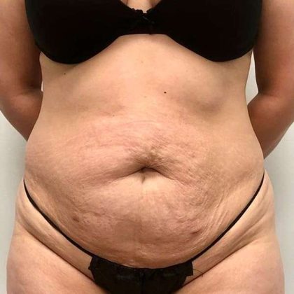 Tummy Tuck Before & After Patient #379