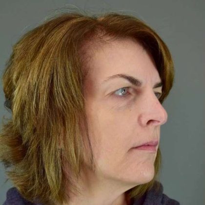 Eyelid Surgery Before & After Patient #1786