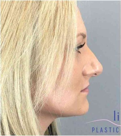 Rhinoplasty Before & After Patient #1807