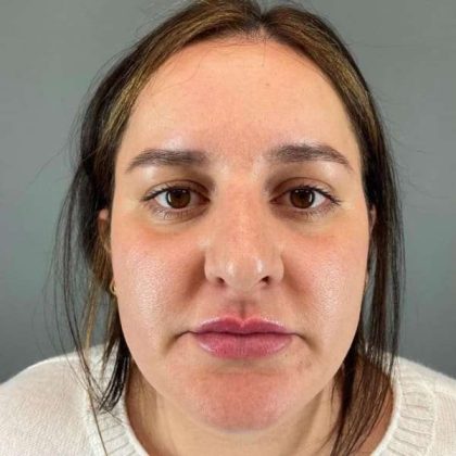 Rhinoplasty Before & After Patient #1818