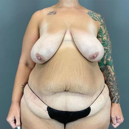 Breast Reduction Before & After Patient #1826