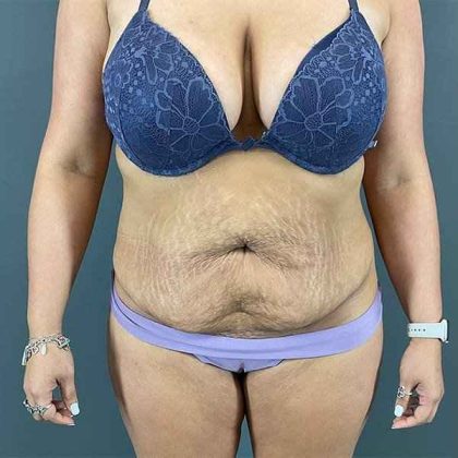 Tummy Tuck Before & After Patient #390