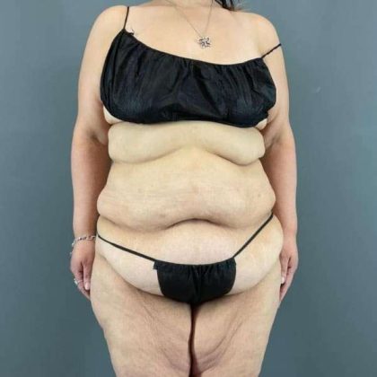 Tummy Tuck Before & After Patient #401