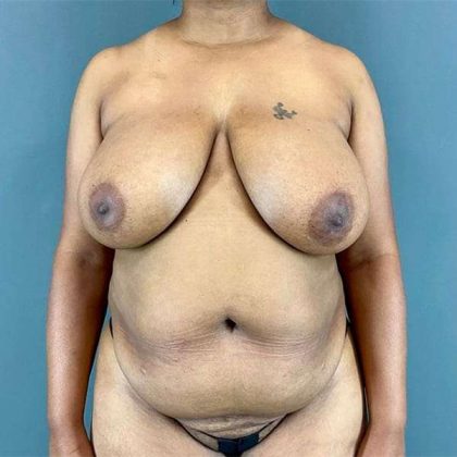 Tummy Tuck Before & After Patient #412
