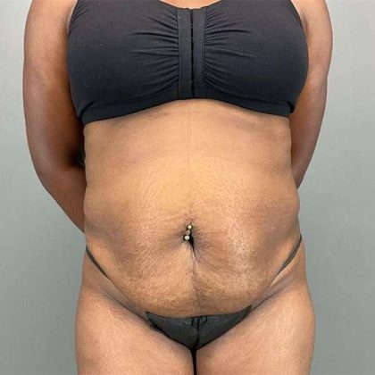 Tummy Tuck Before & After Patient #423