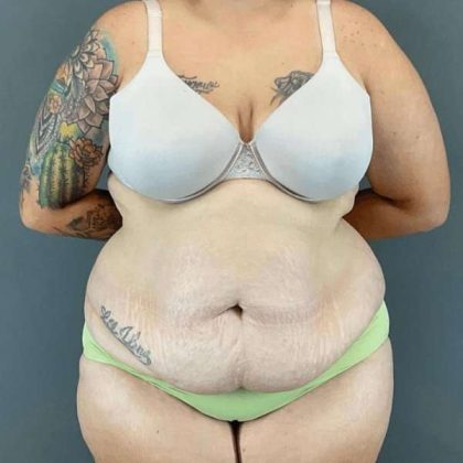 Tummy Tuck Before & After Patient #434