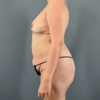 Tummy Tuck Before & After Patient #445