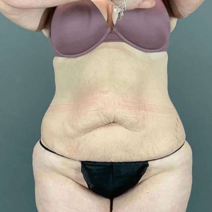Tummy Tuck Before & After Patient #476