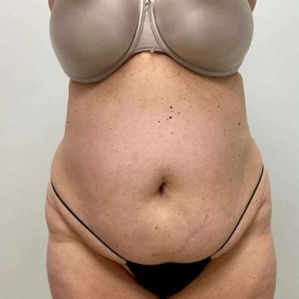 Tummy Tuck Before & After Patient #498