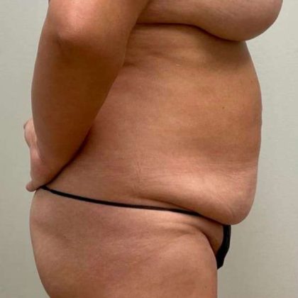 Tummy Tuck Before & After Patient #509