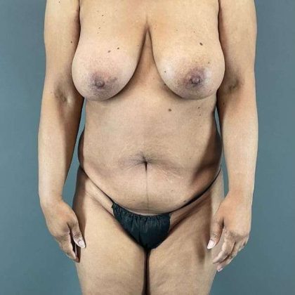Tummy Tuck Before & After Patient #531