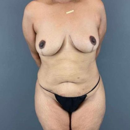 Tummy Tuck Before & After Patient #542
