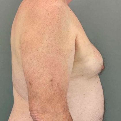 Gynecomastia Before & After Patient #571
