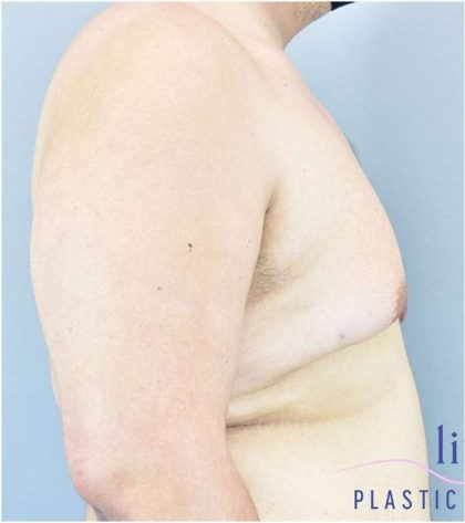 Gynecomastia Before & After Patient #582