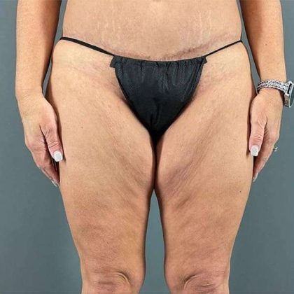 Thigh Lift Before & After Patient #233