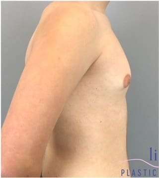 Gynecomastia Before & After Patient #593