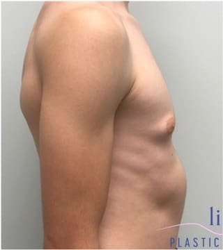 Gynecomastia Before & After Patient #604