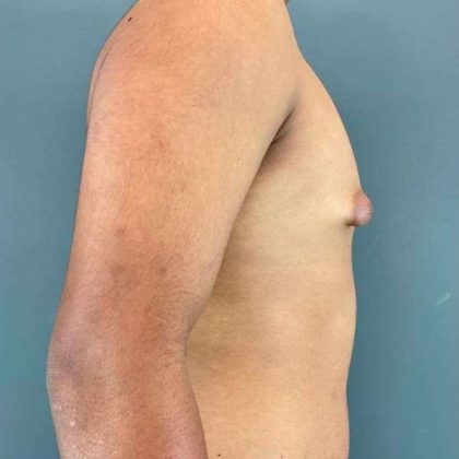 Gynecomastia Before & After Patient #622
